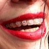 Orthodontic Treatment